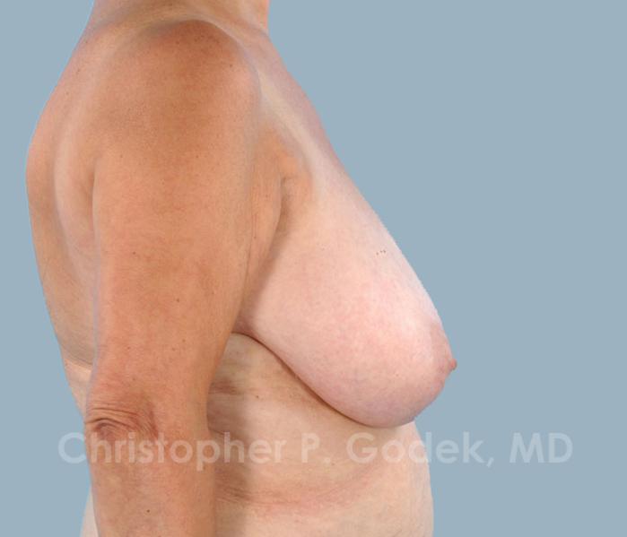 Breast Reduction Before & After Image