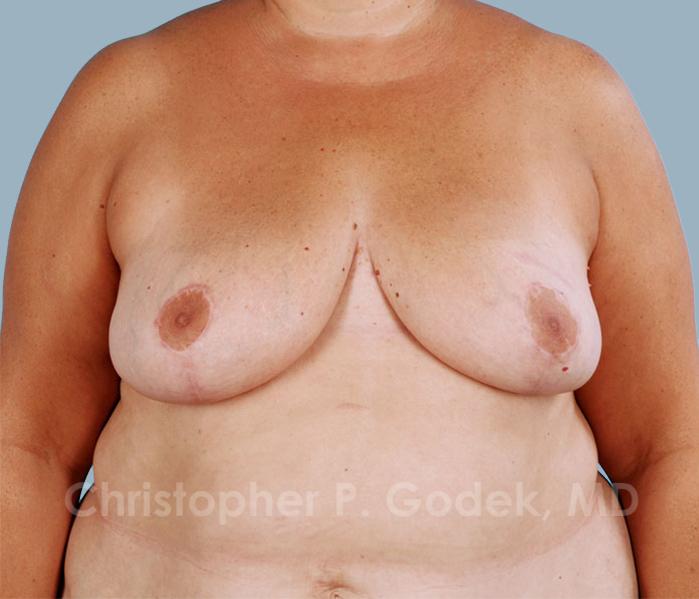Breast Reduction Before & After Image