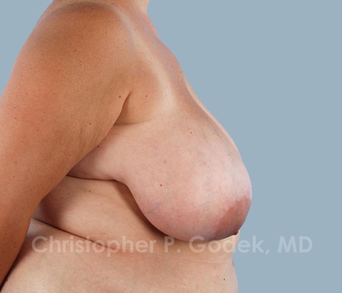 Breast Reduction Before & After Image