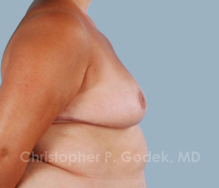 Breast Reduction Before & After Image