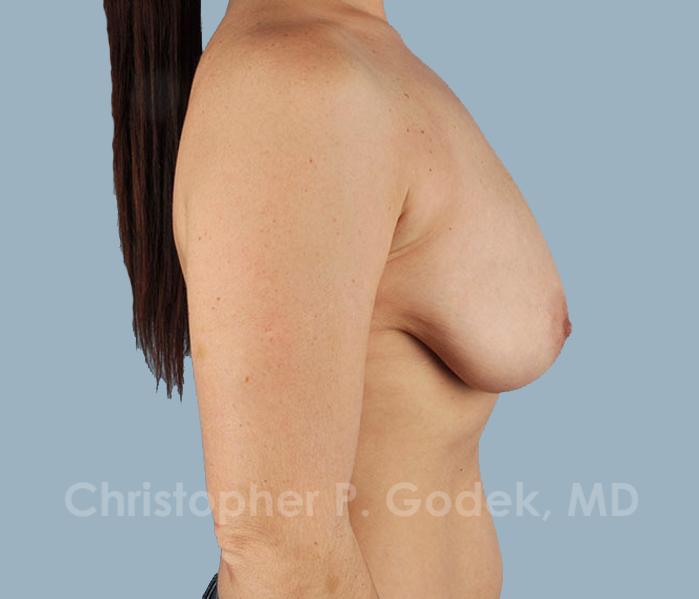 Breast Reduction Before & After Image
