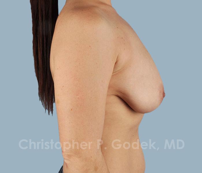 Breast Reduction Before & After Image