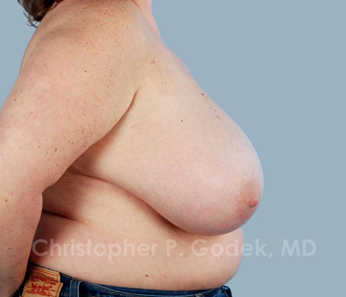 Breast Reduction Before & After Image