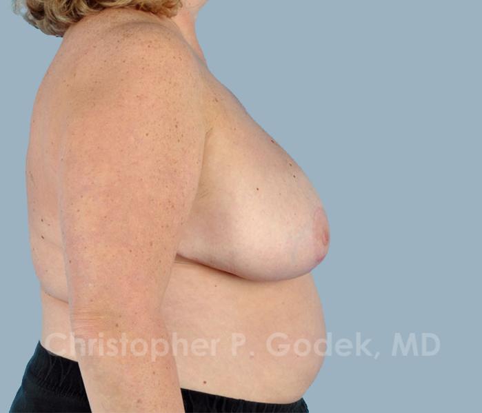 Breast Reduction Before & After Image