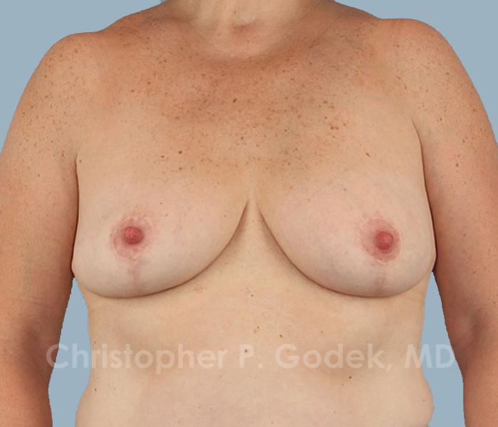 Breast Reduction Before & After Image