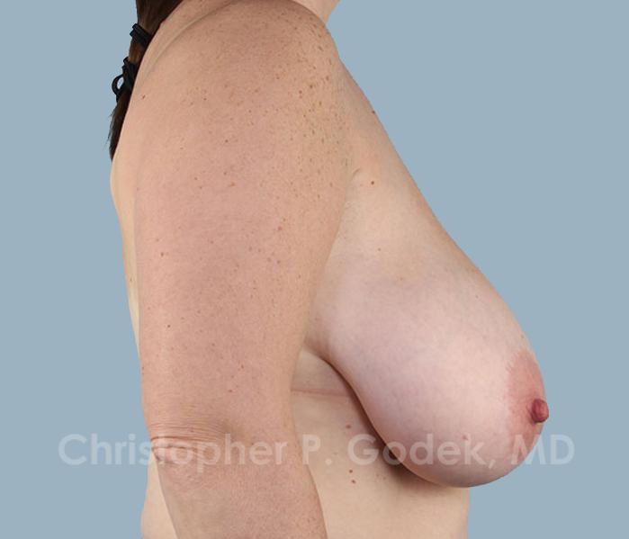 Breast Reduction Before & After Image