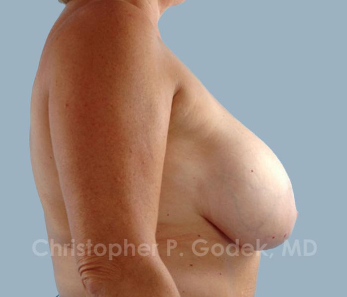 Breast Reduction Before & After Image