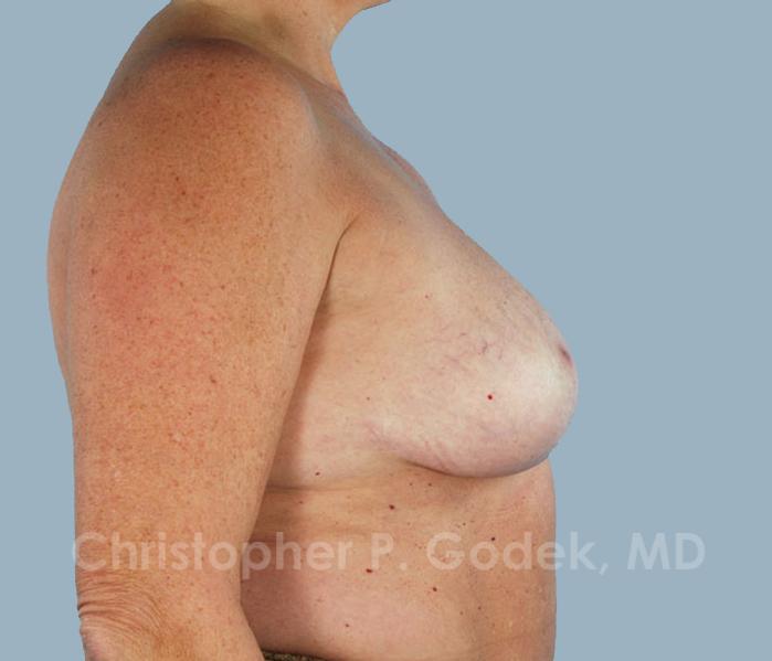 Breast Reduction Before & After Image