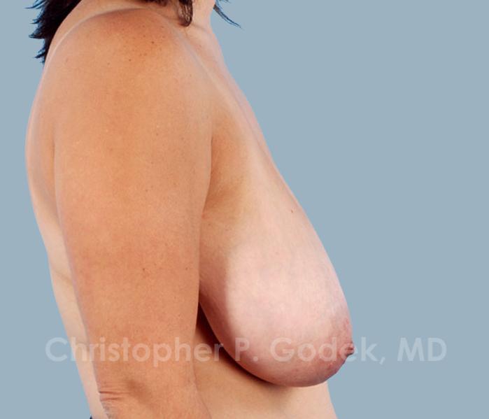 Breast Reduction Before & After Image