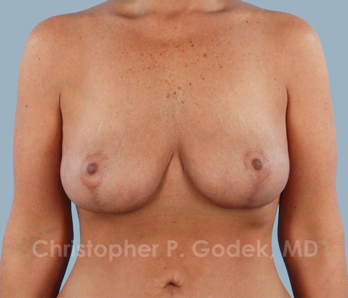 Breast Reduction Before & After Image