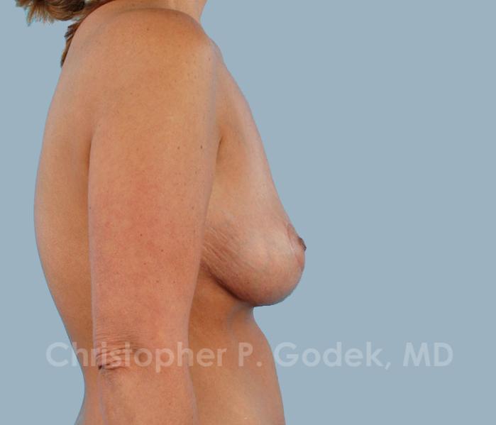 Breast Reduction Before & After Image