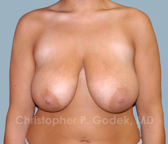 Breast Reduction Before & After Image