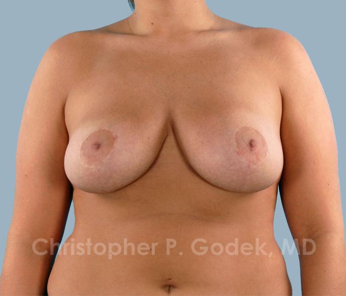 Breast Reduction Before & After Image