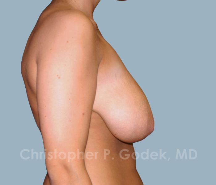 Breast Reduction Before & After Image