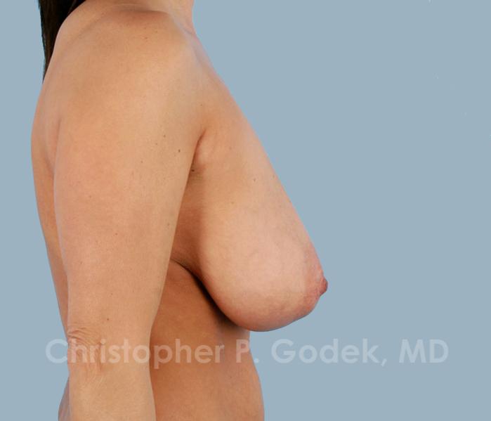 Breast Reduction Before & After Image