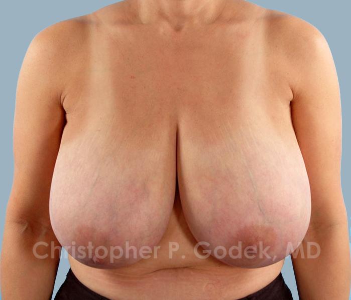 Breast Reduction Before & After Image