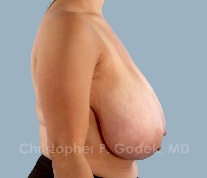 Breast Reduction Before & After Image