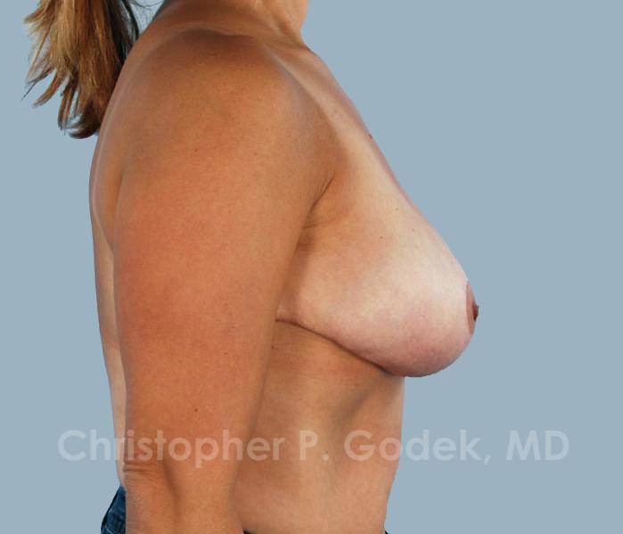 Breast Reduction Before & After Image