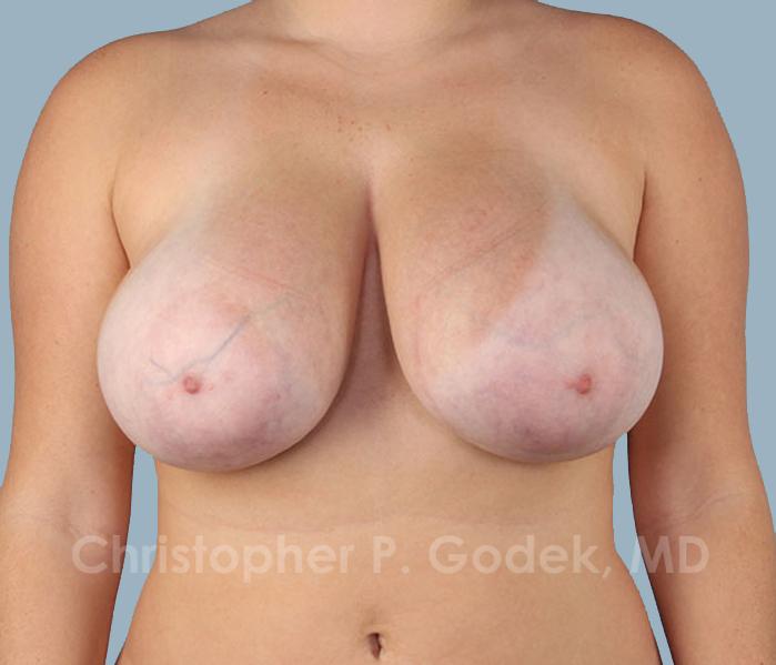 Breast Reduction Before & After Image