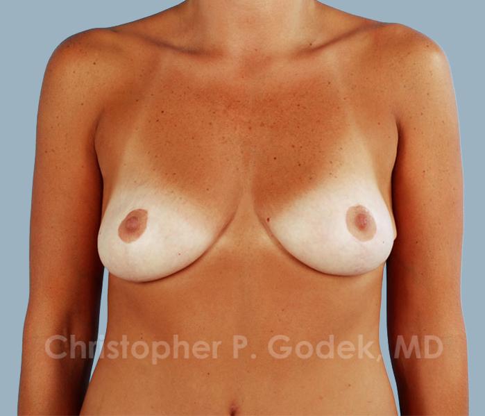 Breast Reduction Before & After Image