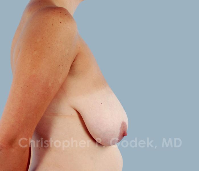 Breast Reduction Before & After Image