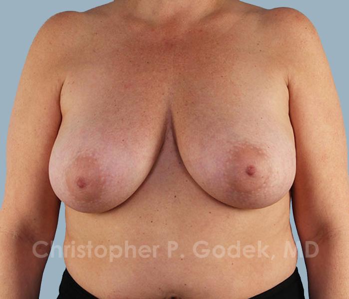 Breast Reduction Before & After Image