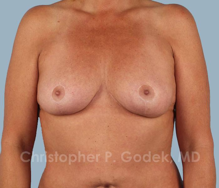 Breast Reduction Before & After Image