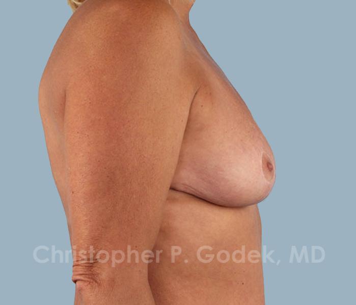 Breast Reduction Before & After Image