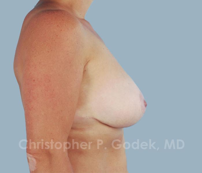 Breast Reduction Before & After Image