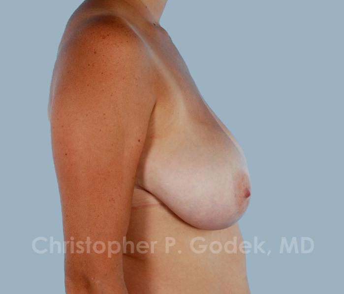 Breast Reduction Before & After Image