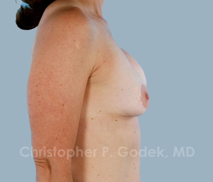 Breast Revision Before & After Image