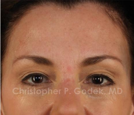 Eyelid Lift Before & After Image