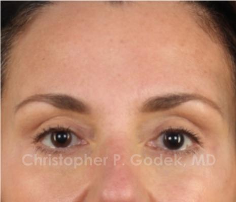 Eyelid Lift Before & After Image