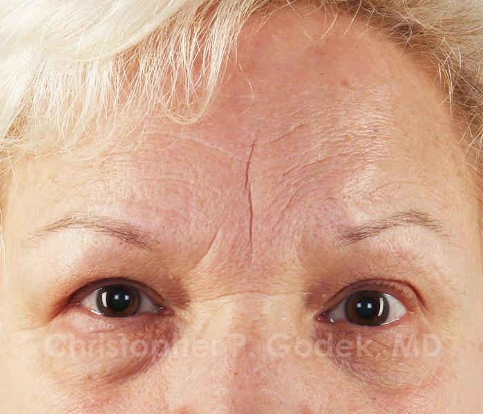 Eyelid Lift Before & After Image