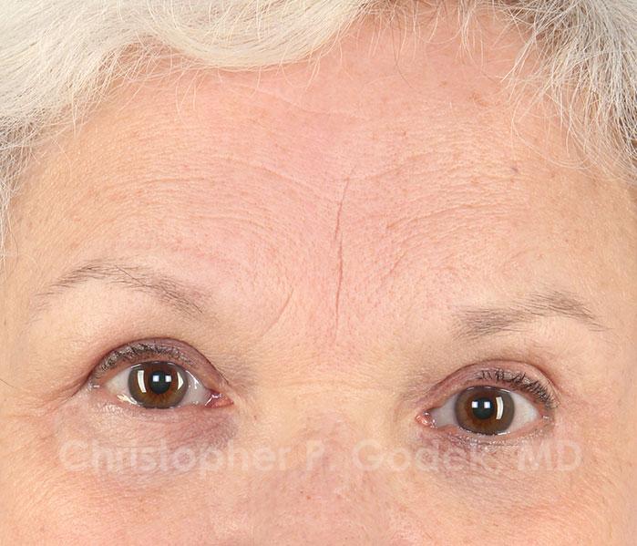 Eyelid Lift Before & After Image