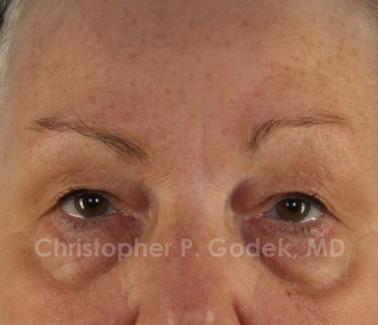 Eyelid Lift Before & After Image