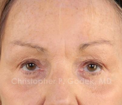 Eyelid Lift Before & After Image