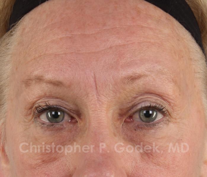 Eyelid Lift Before & After Image