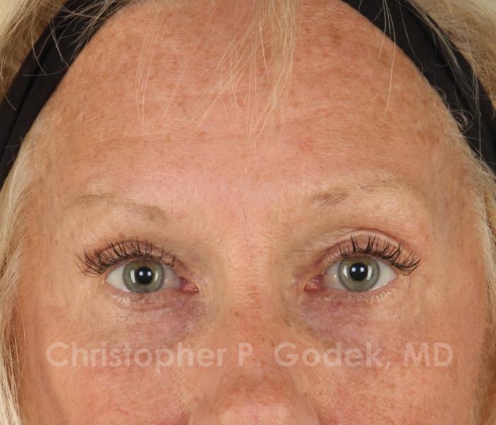 Eyelid Lift Before & After Image