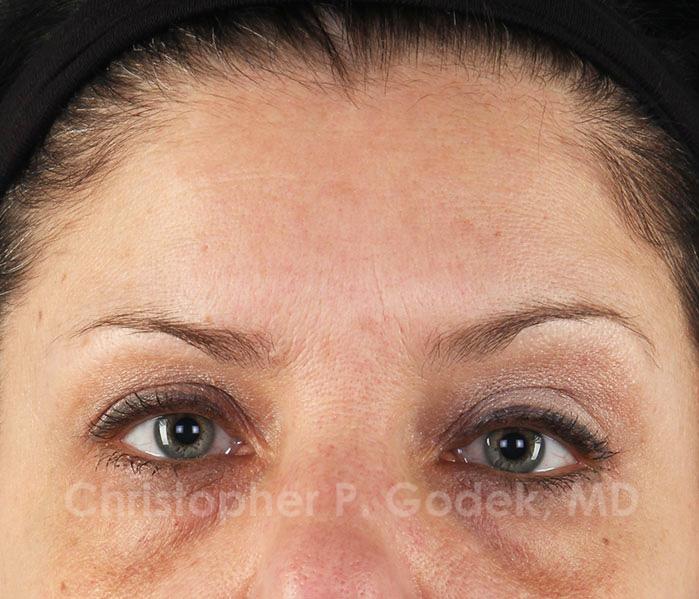 Eyelid Lift Before & After Image