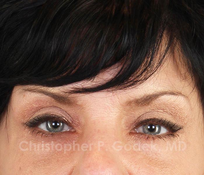 Eyelid Lift Before & After Image