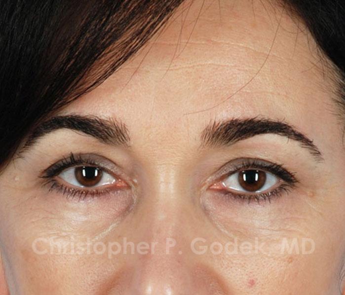 Eyelid Lift Before & After Image