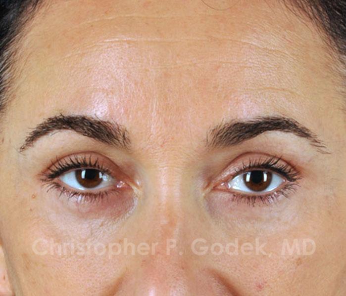 Eyelid Lift Before & After Image