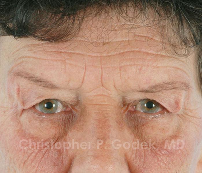 Eyelid Lift Before & After Image