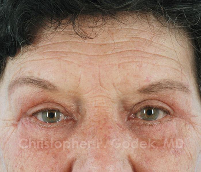 Eyelid Lift Before & After Image