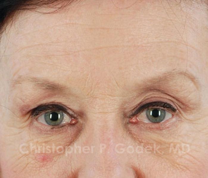 Eyelid Lift Before & After Image