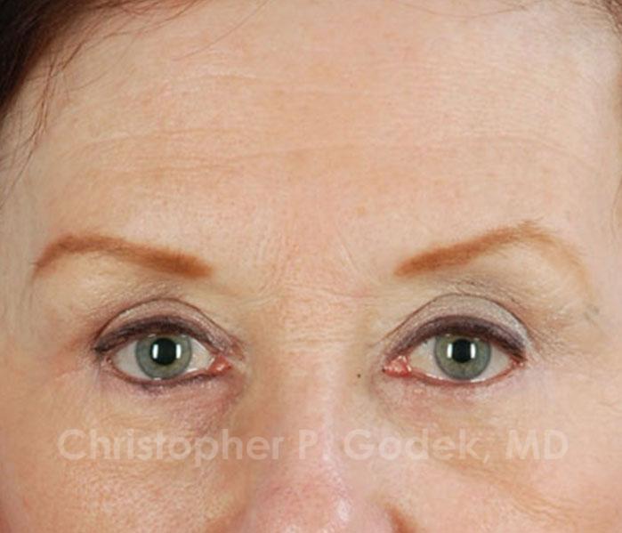 Eyelid Lift Before & After Image