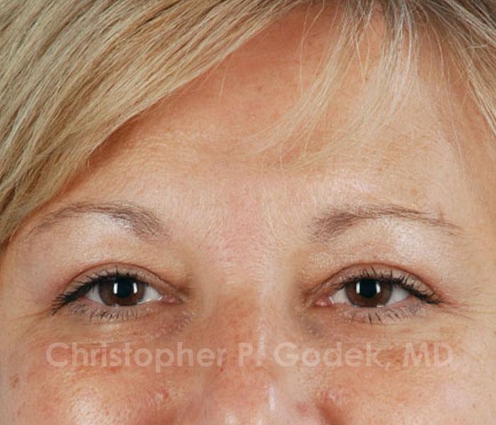 Eyelid Lift Before & After Image