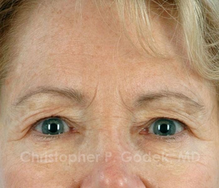 Eyelid Lift Before & After Image