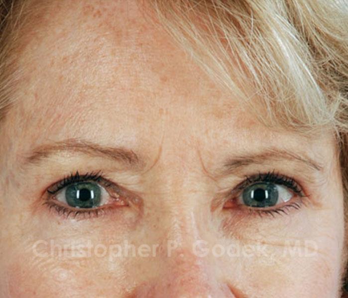 Eyelid Lift Before & After Image